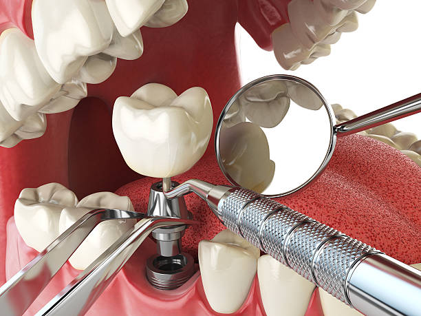Best Emergency Dentist for Knocked-Out Tooth in Roscommon, MI